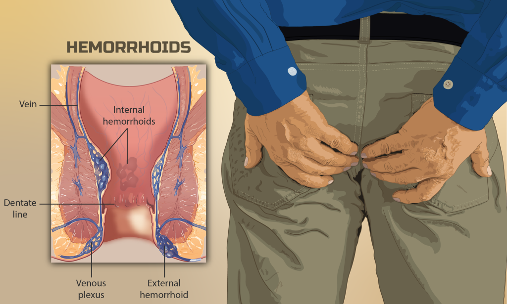 Herbal Remedies for Piles: Cure Piles In 3 Days  without surgery