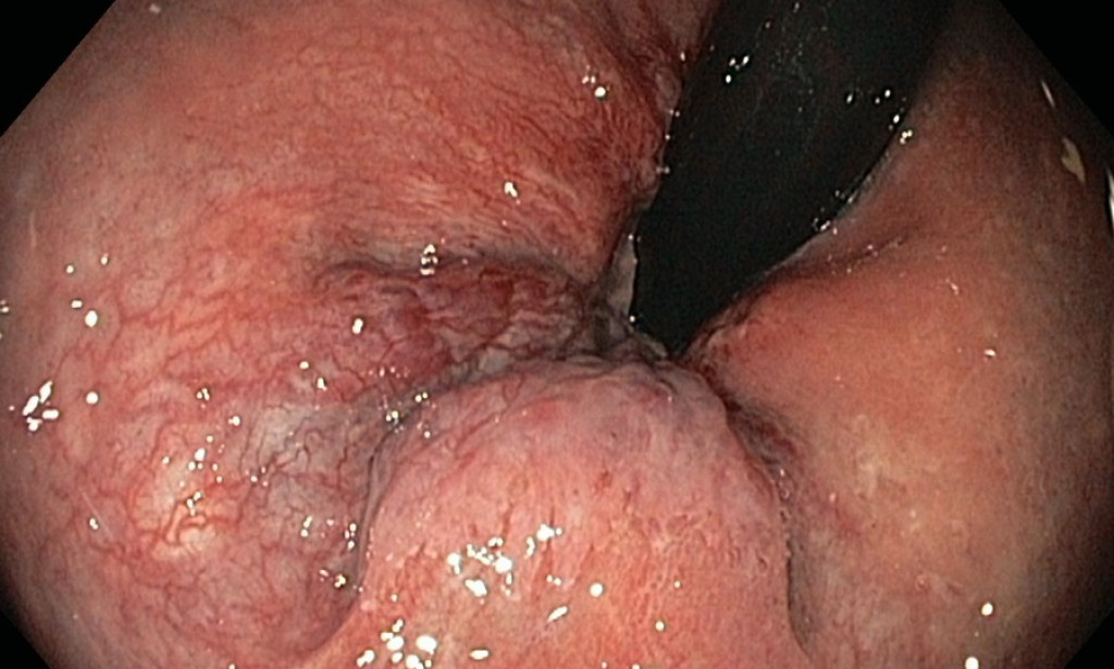 How Can I Reduce the Symptoms of Piles and Prevent Them From Occurring?