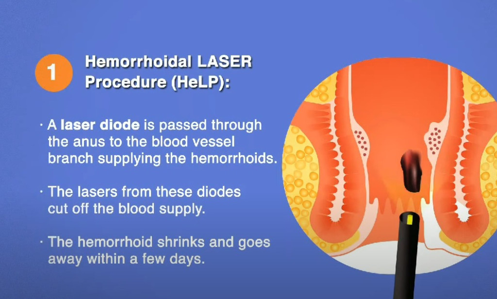 Laser treatment for Piles: Cure Piles in 4 days