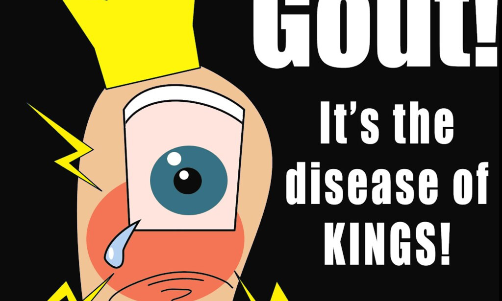 Gout Myths and Treatments: Latest Recommendations from the UK  National Institute for Health and Care Excellence(NICE)