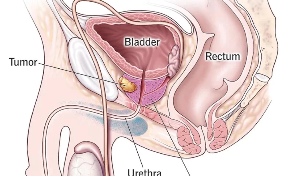 Herbal Ways to Treat Prostrate Cancer Fast